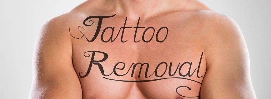 Preparing for Tattoo Removal - Pre-Treatment Guidelines