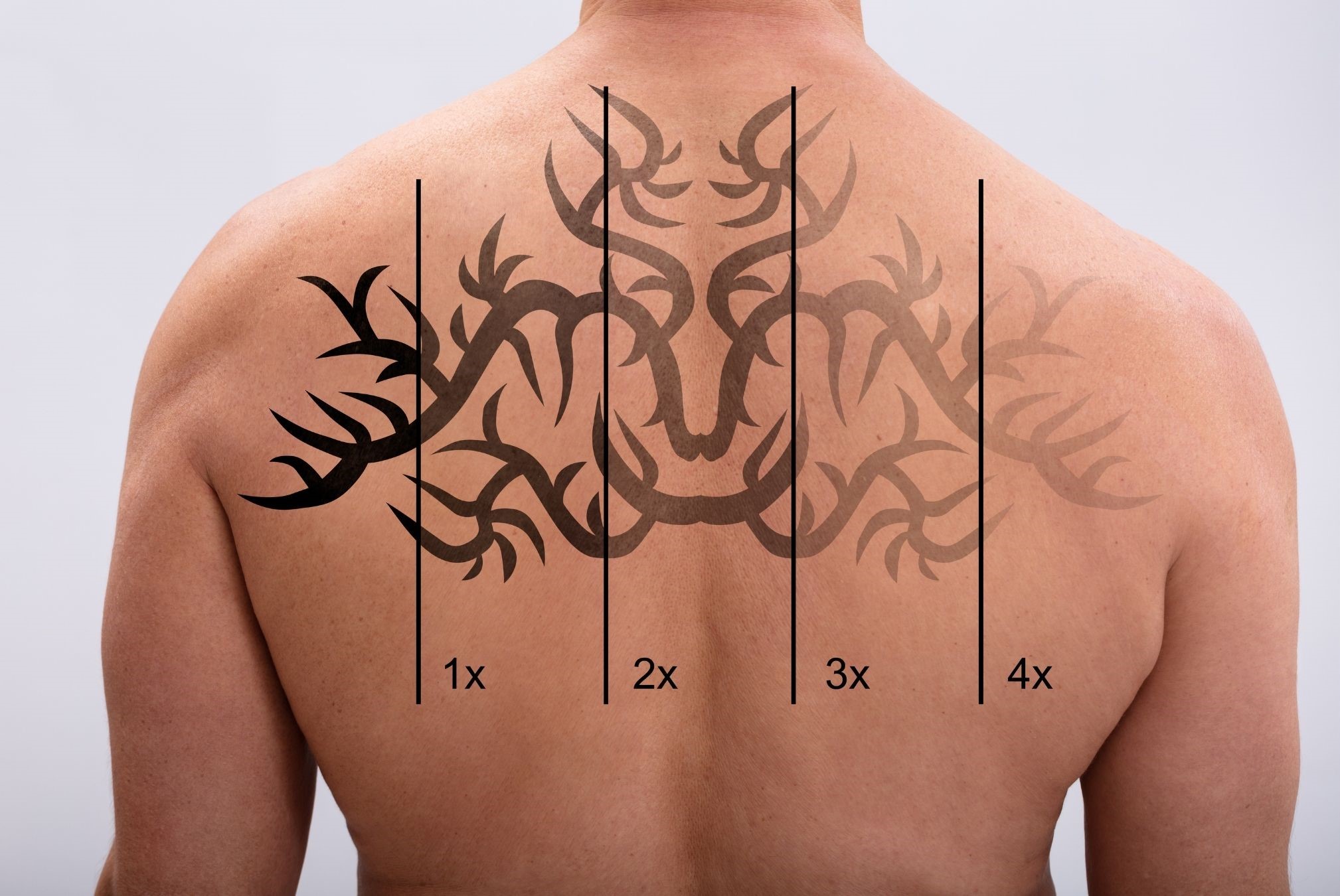 Tattoo Lightening Methods and Their Outcomes