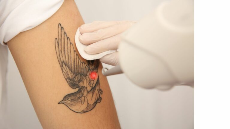 Tattoo Removal: Choosing the Right Laser Technology