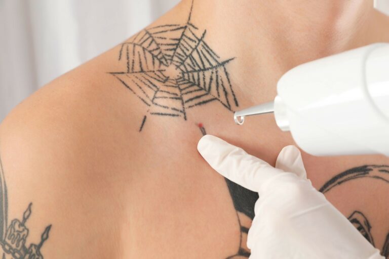 Understanding the Tattoo Removal Process