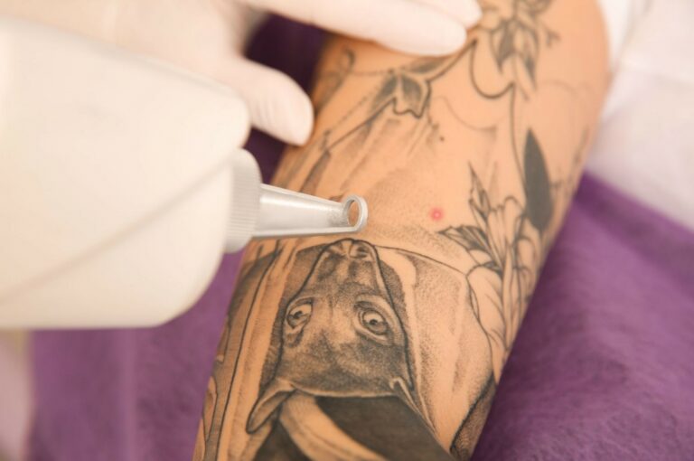 Fade Away: A Comprehensive Guide to Understanding Tattoo Removal