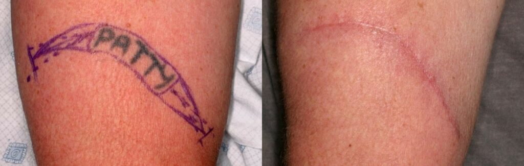 Tattoo-Removal-Surgical-excision-Visakhapatnam-2