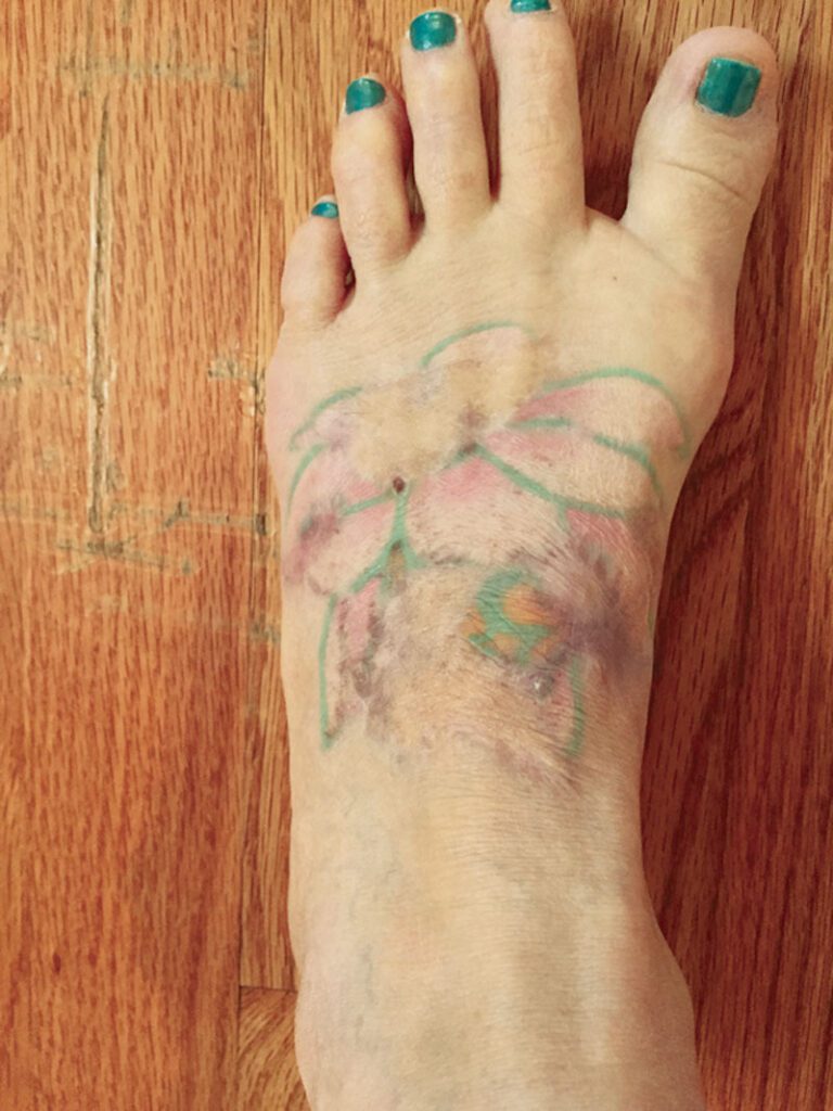 Fig. 2. Tattoo after skin graft. The tattoo is no longer reactive, and the skin graft has taken well, with minimal erythema and scarring.